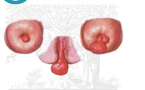 Hình ảnh polyp cổ tử cung có các khối u chèn ép cổ tử cung có thể gây vô sinh