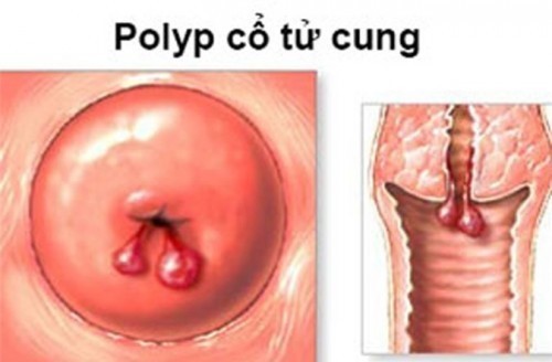 Hình ảnh polyp cổ tử cung có nhiều polyp