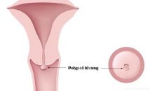 Những hình ảnh polyp cổ tử cung ở phụ nữ dễ nhận biết nhất
