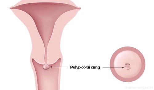 Hình ảnh polyp cổ tử cung do sự phát triển quá mức của nội mạc tử cung
