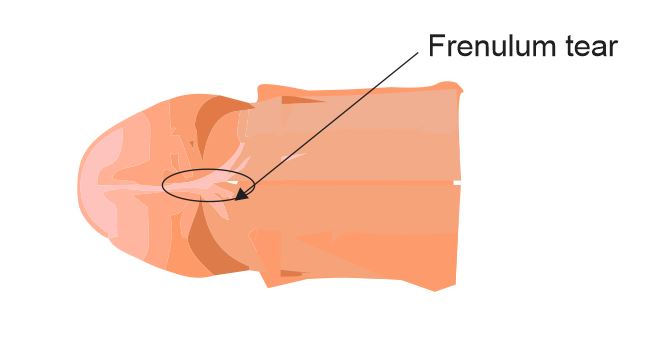 Dây hãm bao quy đầu split frenulum diagram 